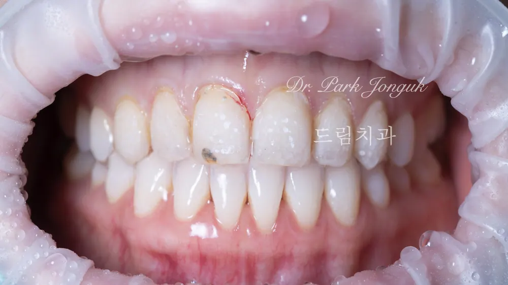 부자연스럽고 어색한 라미네이트의 재시술 본문 사진 2