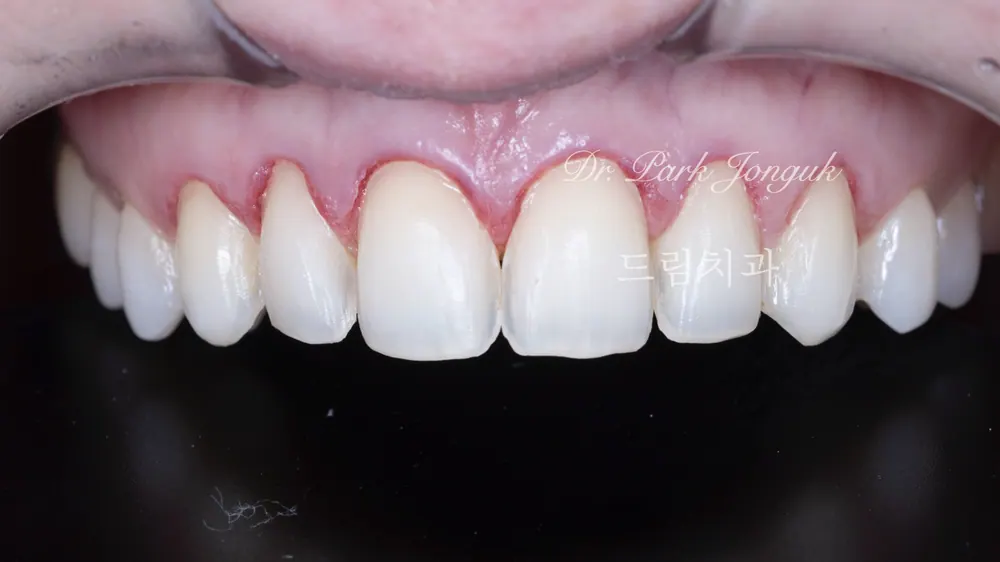 부자연스럽고 어색한 라미네이트의 재시술 본문 사진 3