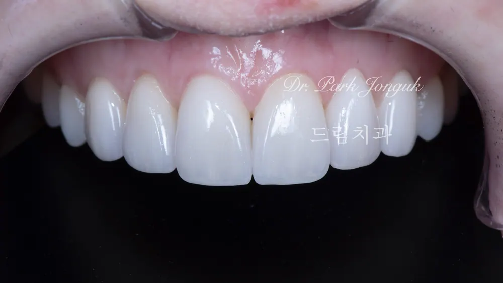 부자연스럽고 어색한 라미네이트의 재시술 본문 사진 4