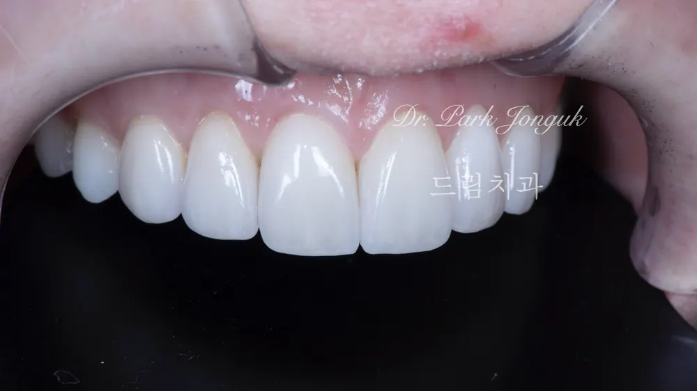 부자연스럽고 어색한 라미네이트의 재시술 본문 사진 5