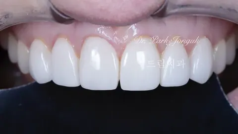부자연스럽고 어색한 라미네이트의 재시술