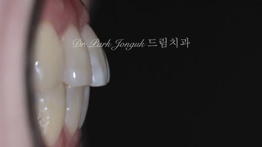 라미네이트 잘하는곳 아름다움을 살리는 라미네이트 치료 본문 사진 2