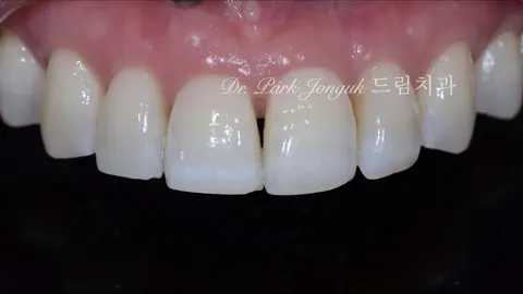 라미네이트 잘하는곳 아름다움을 살리는 라미네이트 치료
