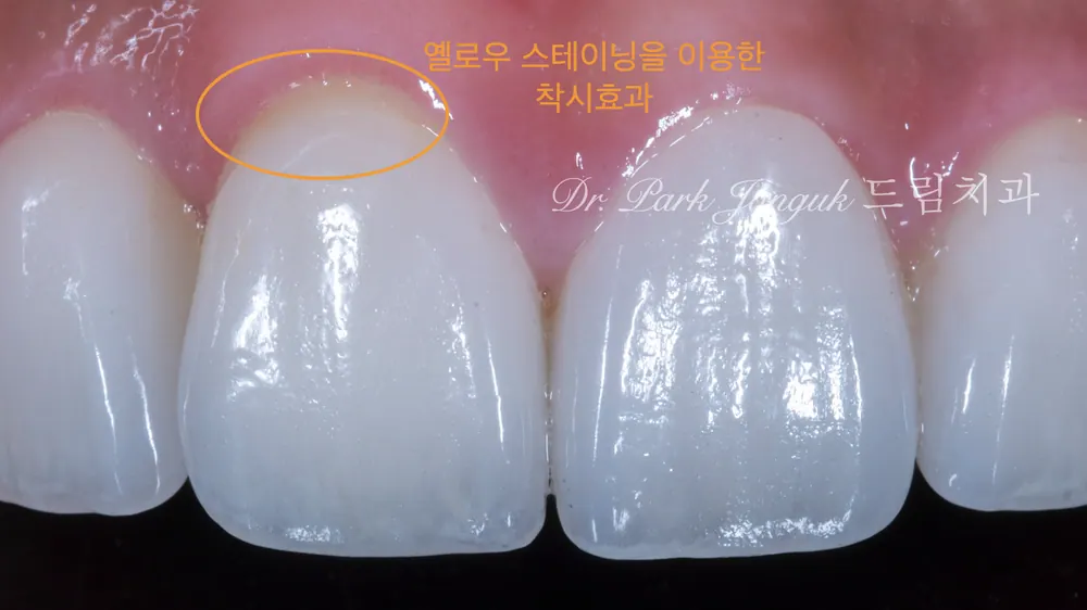 무삭제 라미네이트와 삭제하는 라미네이트의 조화 본문 사진 11