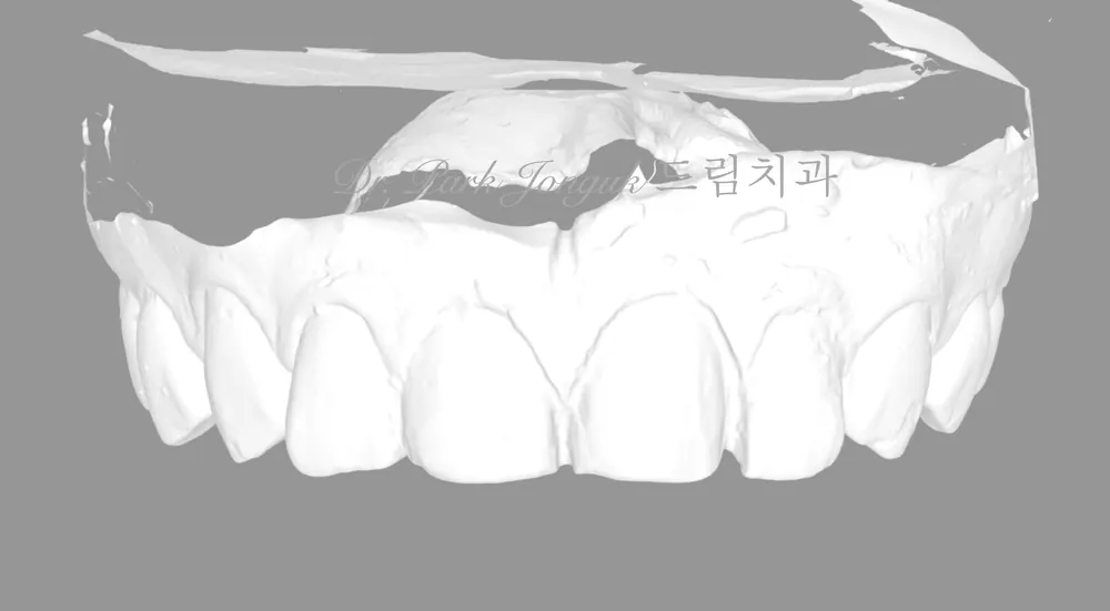 좋은 라미네이트란 무엇일까? 본문 사진 5