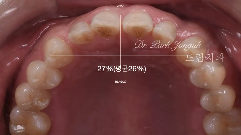 무삭제 라미네이트 시술부터 관리까지 본문 사진 4