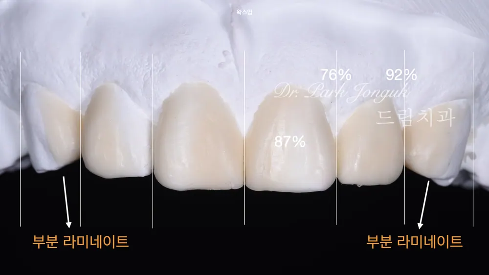 무삭제 라미네이트 시술부터 관리까지 본문 사진 5