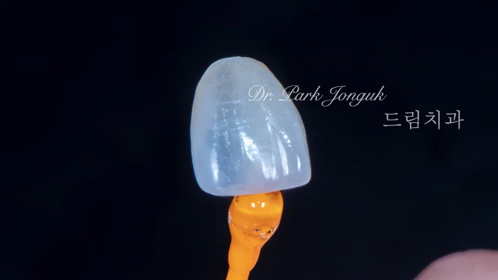 무삭제 라미네이트 시술부터 관리까지 본문 사진 8