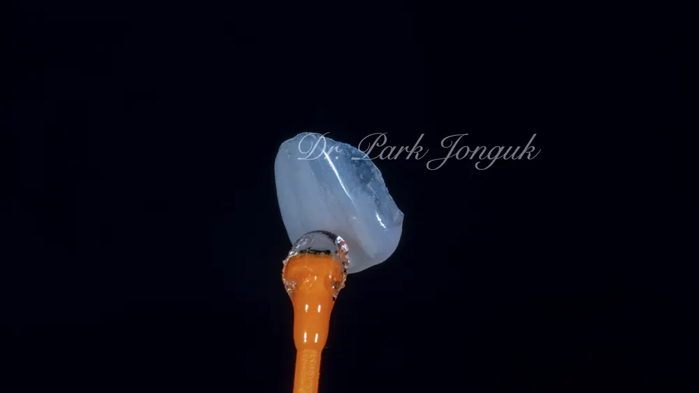 무삭제 라미네이트 모두가 가능할까요? 본문 사진 4