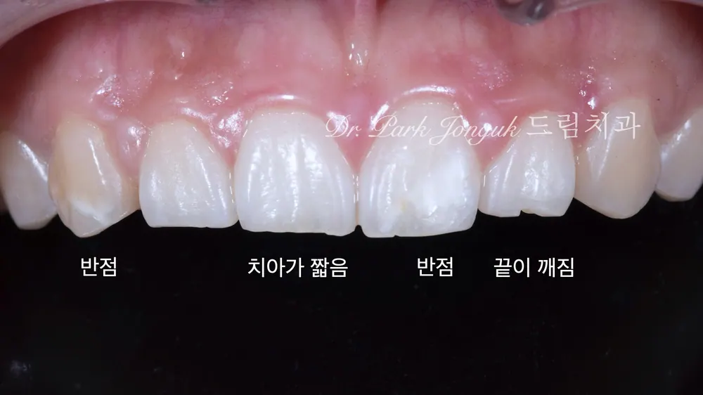 라미네이트치과 최소 삭제로 만드는 자연스러움 본문 사진 2