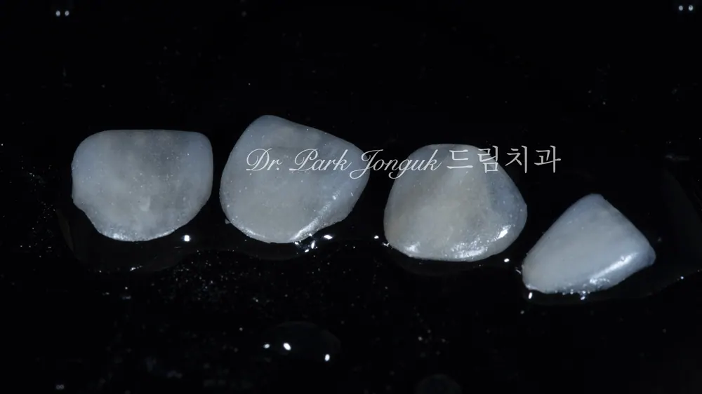 라미네이트치과 최소 삭제로 만드는 자연스러움 본문 사진 4