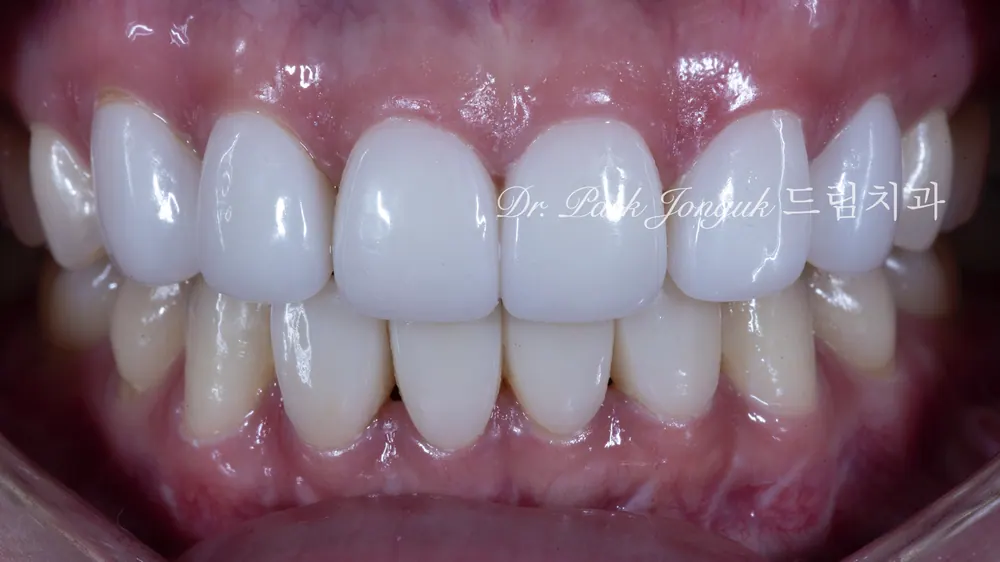 라미네이트 부작용 알아보기 본문 사진 1