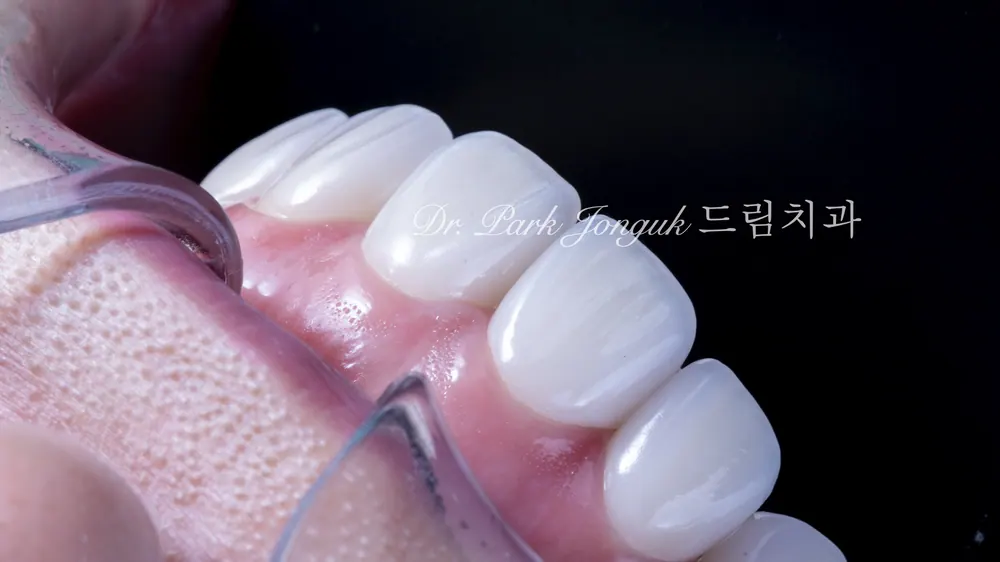 라미네이트 부작용 알아보기 본문 사진 8