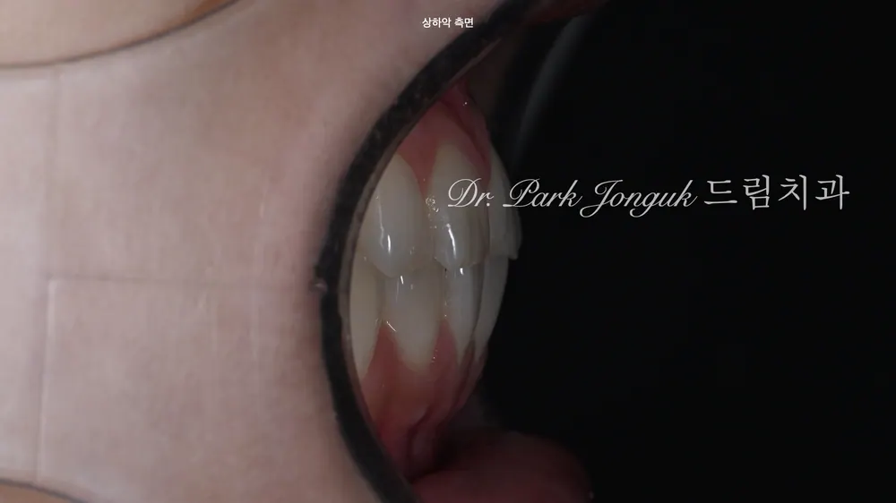 강남 무삭제 라미네이트 잘하는 치과 본문 사진 3