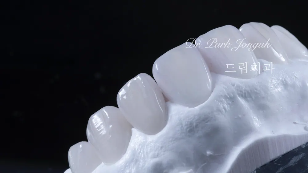 깨진 치아의 미세삭제, 무삭제 라미네이트 치료 본문 사진 5