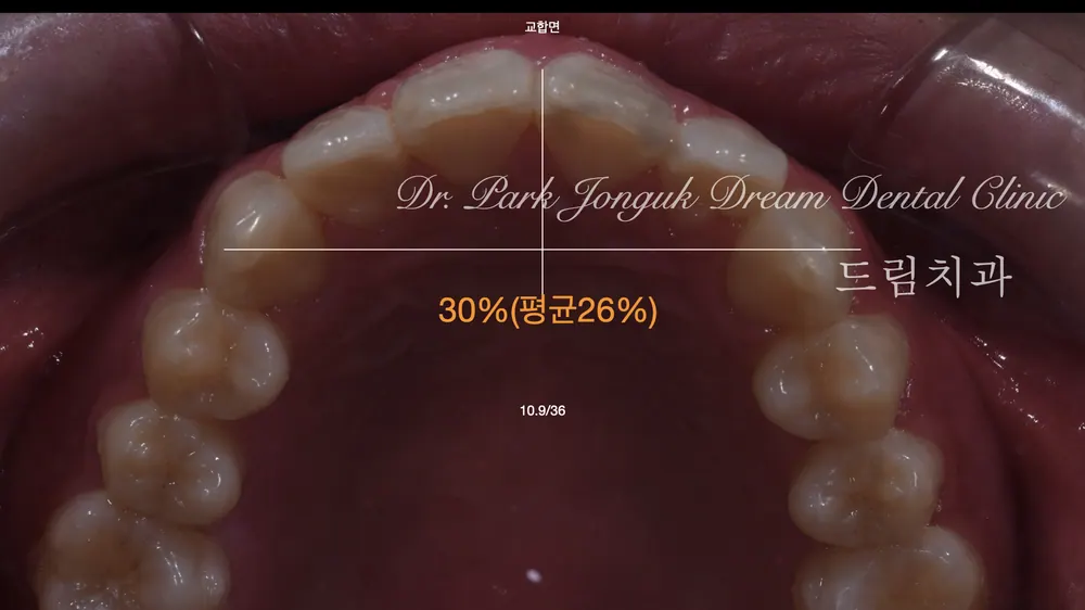 파절이 있는 치아의 자연스러운 라미네이트 치료 본문 사진 5
