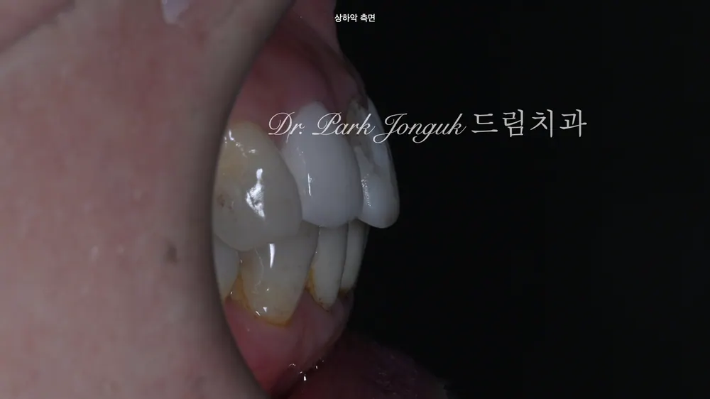 파절된 라미네이트의 재시술 본문 사진 4