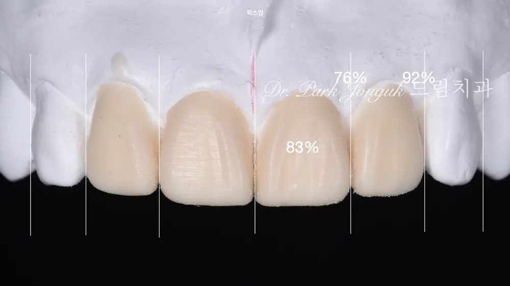 파절된 라미네이트의 재시술 본문 사진 6