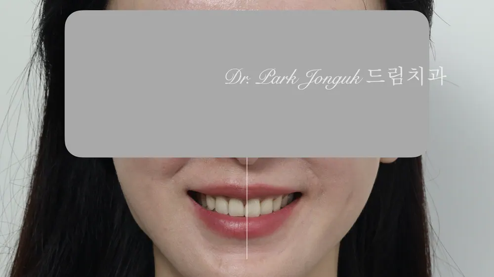 무삭제 라미네이트 모두 가능할까요? 본문 사진 3