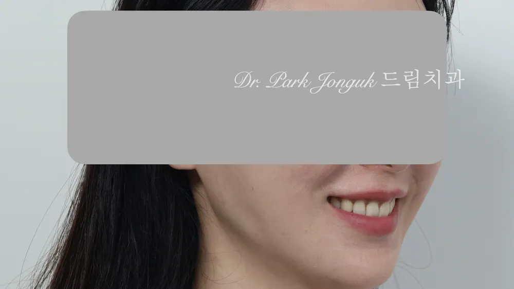 무삭제 라미네이트 모두 가능할까요? 본문 사진 5