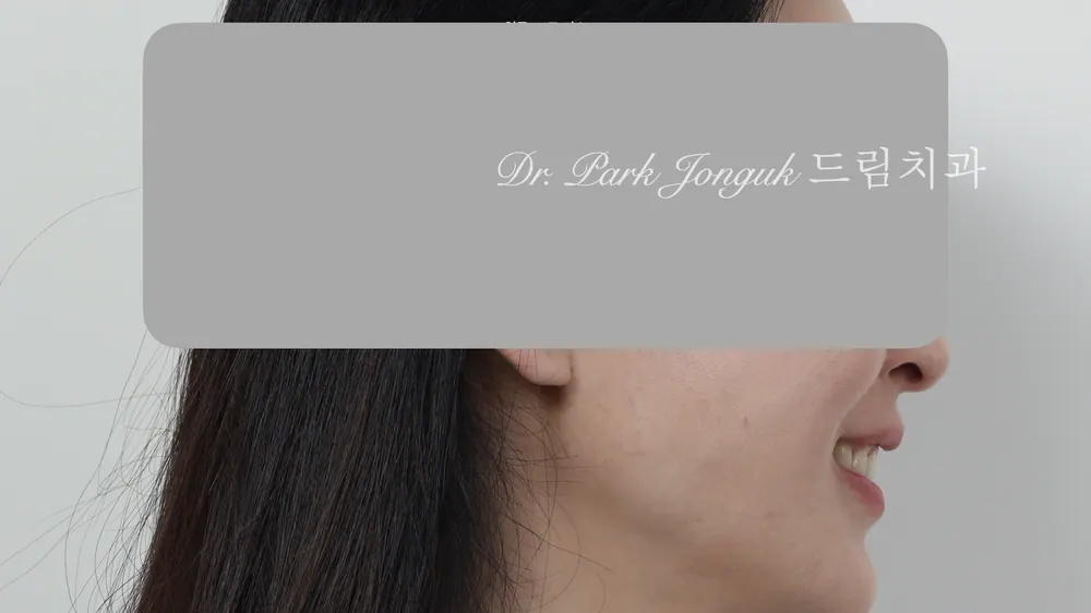 무삭제 라미네이트 모두 가능할까요? 본문 사진 6