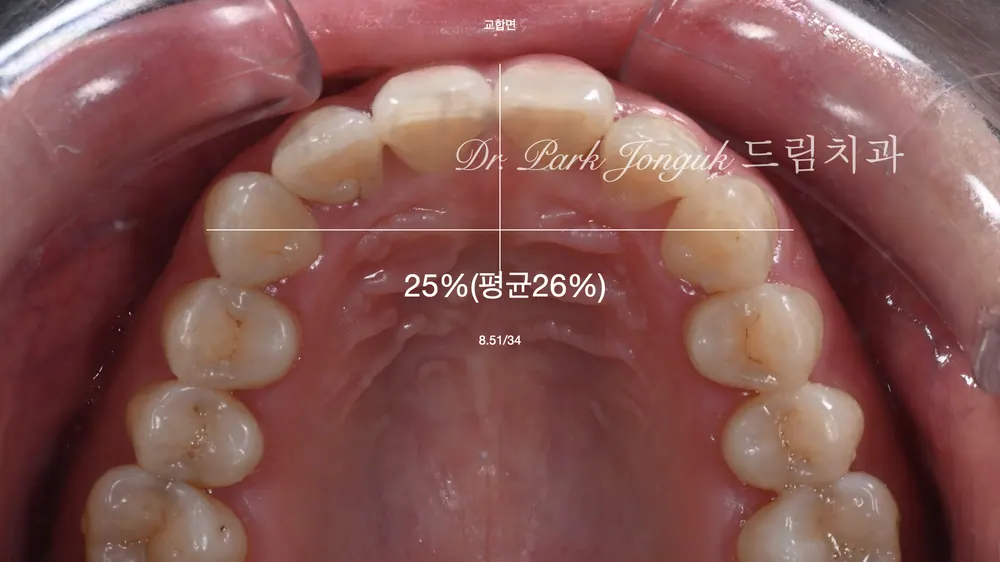 무삭제 라미네이트 모두 가능할까요? 본문 사진 8