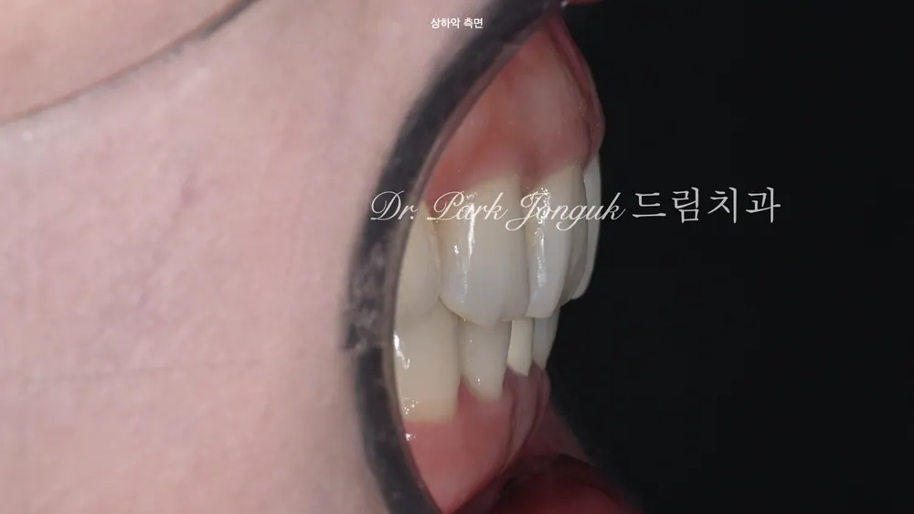 무삭제 라미네이트 모두 가능할까요? 본문 사진 10