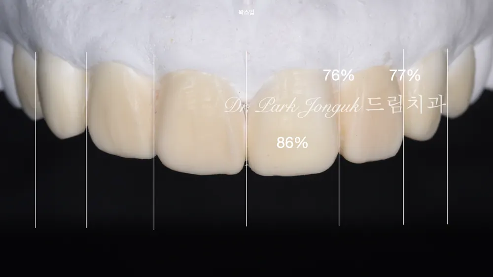 무삭제 라미네이트 모두 가능할까요? 본문 사진 13