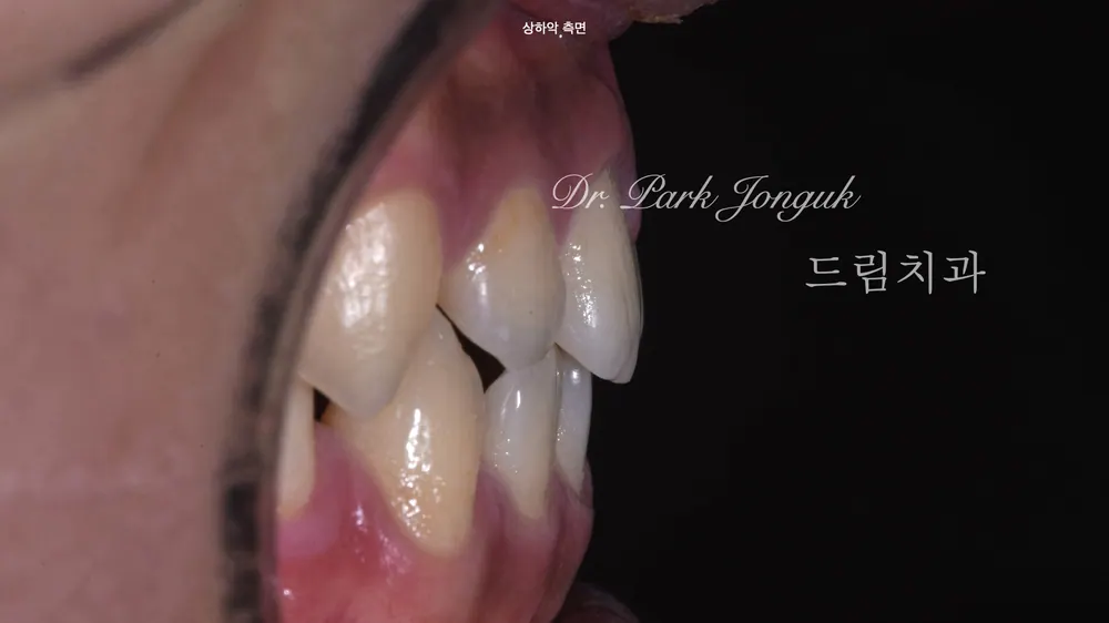 조건이 충족해야 무삭제 라미네이트가 가능합니다 본문 사진 3