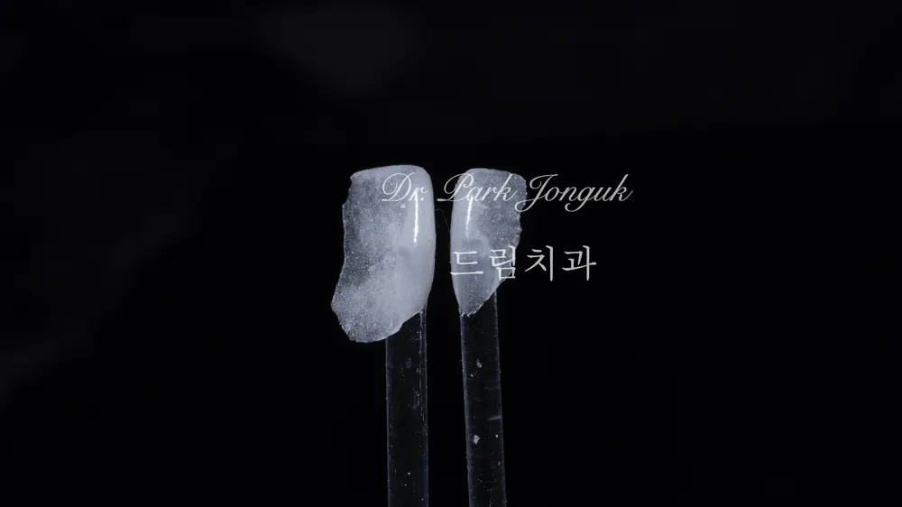 라미네이트 치료 전 상담에서 다양한 질문들 2부 본문 사진 8