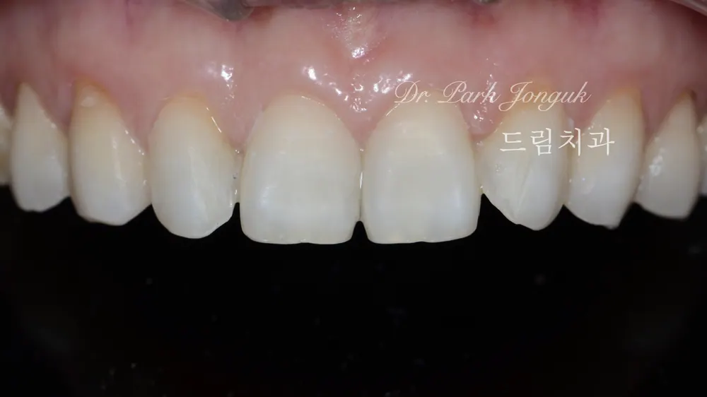 삭제를 최소화하는 미세삭제 라미네이트 본문 사진 2