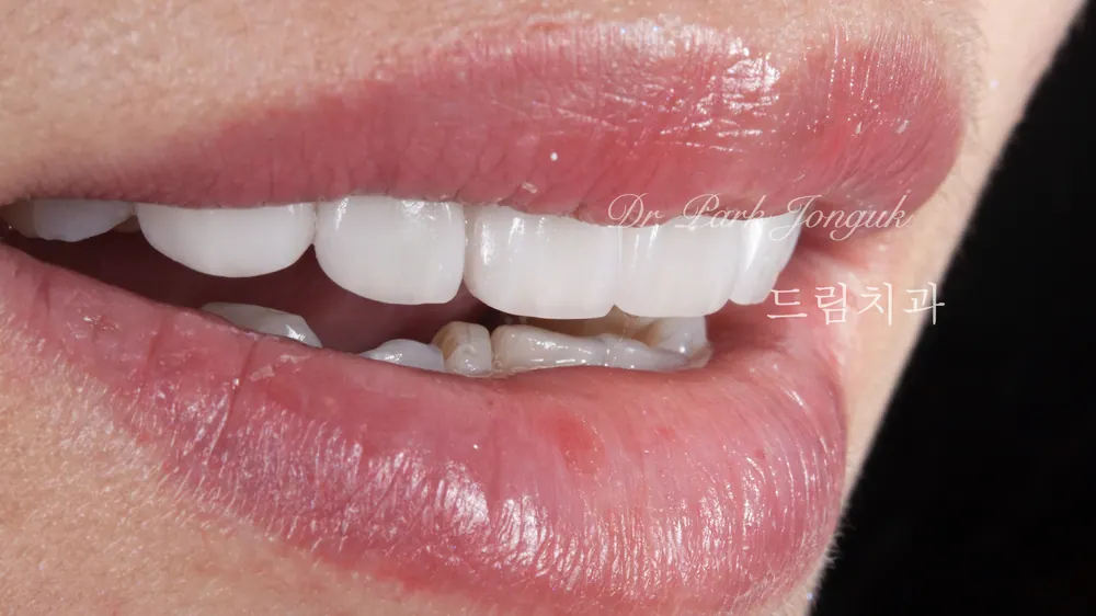 삭제를 최소화하는 미세삭제 라미네이트 본문 사진 7
