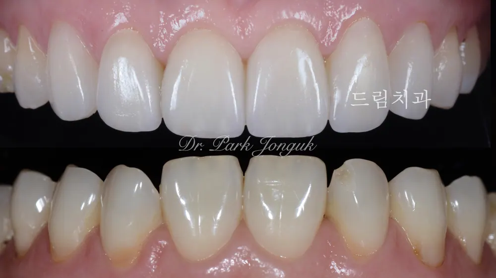 삭제를 최소화하는 미세삭제 라미네이트 본문 사진 8