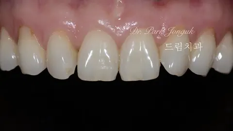 삭제를 최소화하는 미세삭제 라미네이트
