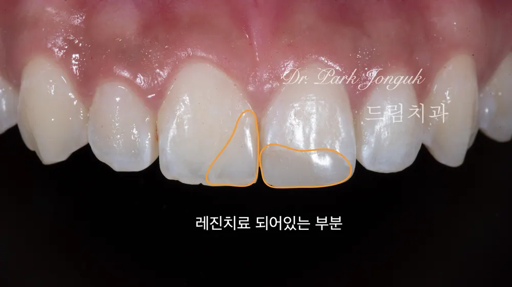 레진 치료되어 있던 치아의 앞니 라미네이트 재치료 본문 사진 2