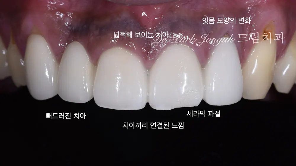 어색한 앞니 브릿지, 올세라믹 크라운의 재시술 본문 사진 2