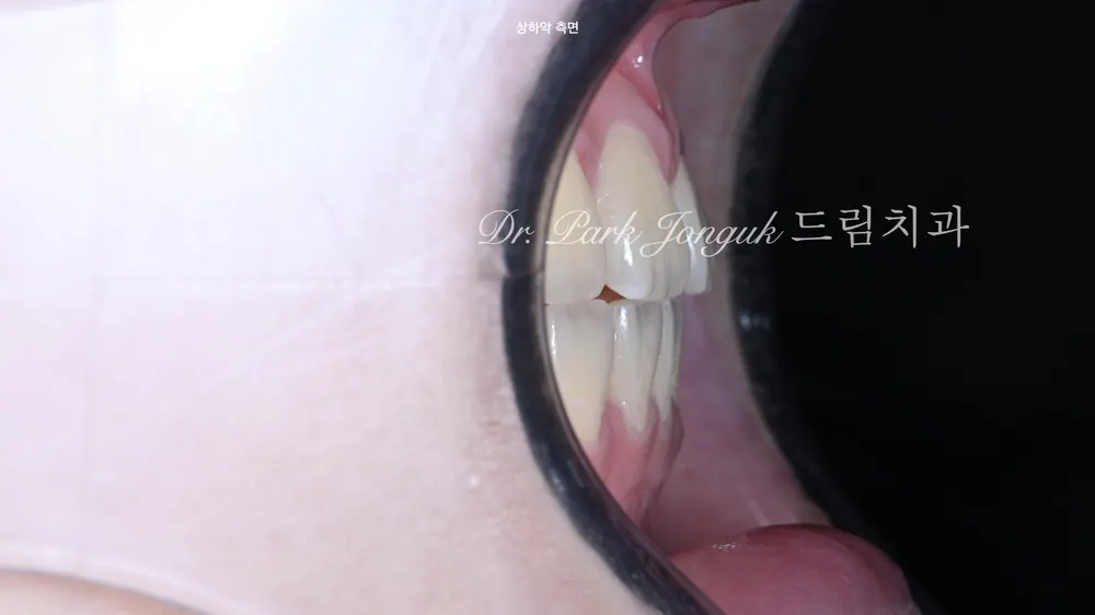 무삭제 라미네이트 치아 삭제를 줄이는 방법 본문 사진 3