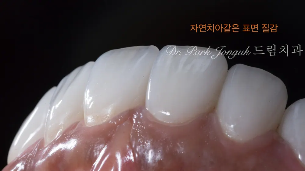 압구정 라미네이트 자연스러움을 추구하는 드림치과 본문 사진 6