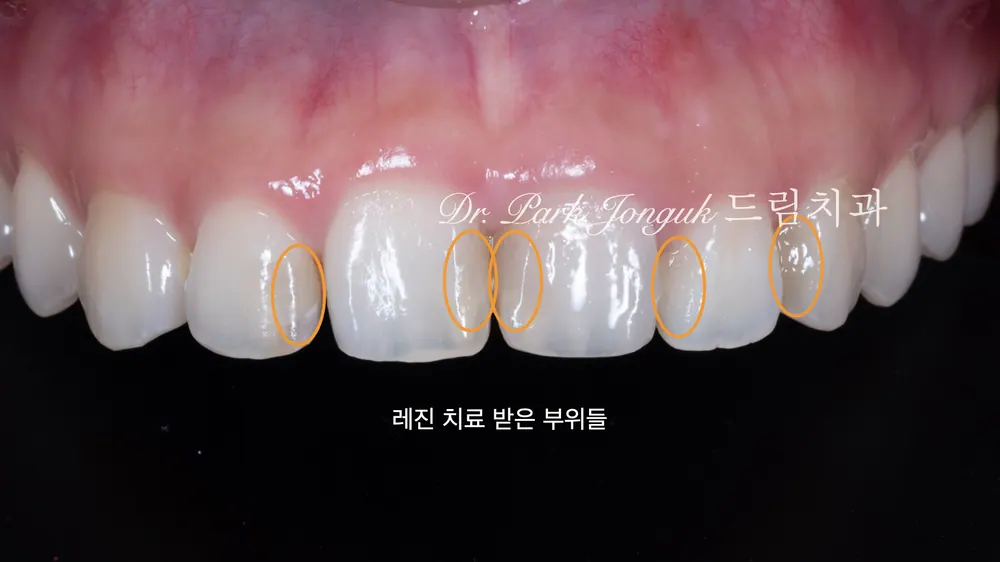 신사동치과 자연스러움을 추구하는 앞니 라미네이트 본문 사진 2