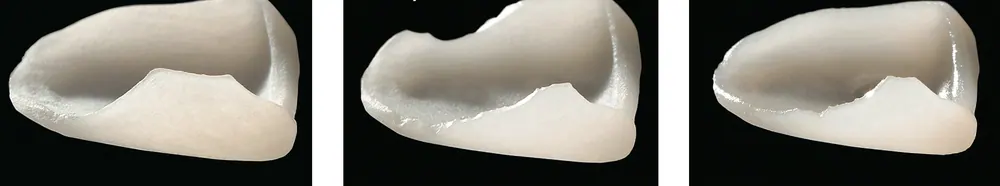 자연스러운 핸드메이트 라미네이트 제작 과정 본문 사진 7