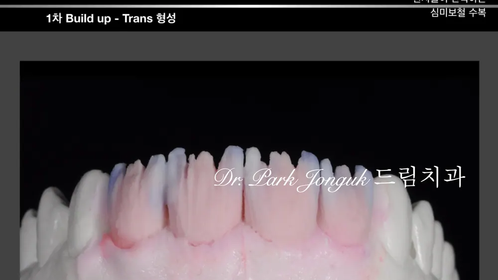 자연스러운 핸드메이트 라미네이트 제작 과정 본문 사진 18