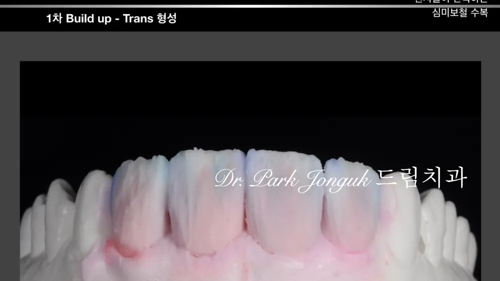 자연스러운 핸드메이트 라미네이트 제작 과정 본문 사진 19
