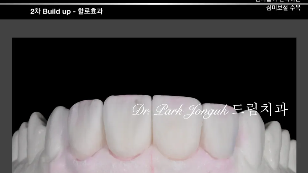 자연스러운 핸드메이트 라미네이트 제작 과정 본문 사진 25