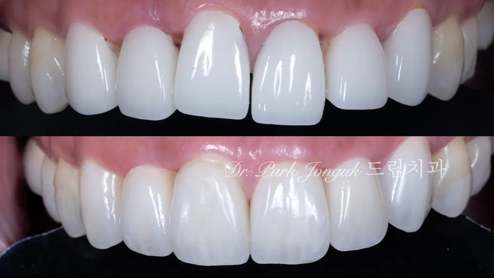 문제가 많은 라미네이트, 올세라믹 크라운의 재시술 본문 사진 11