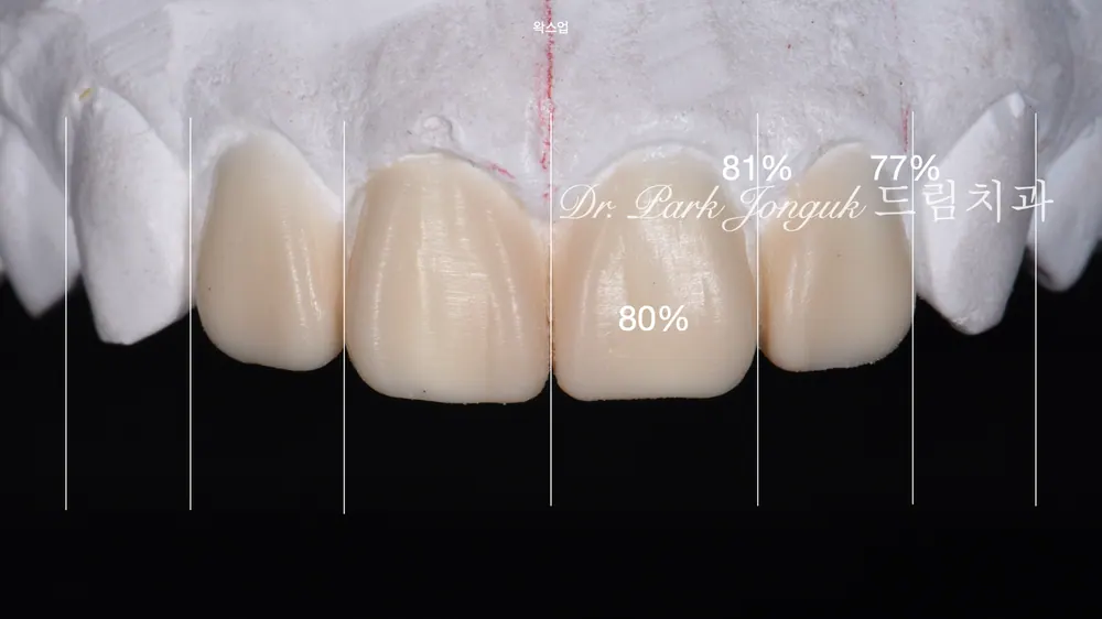 강남 라미네이트 누가봐도 자연스럽고 조화롭게 본문 사진 6