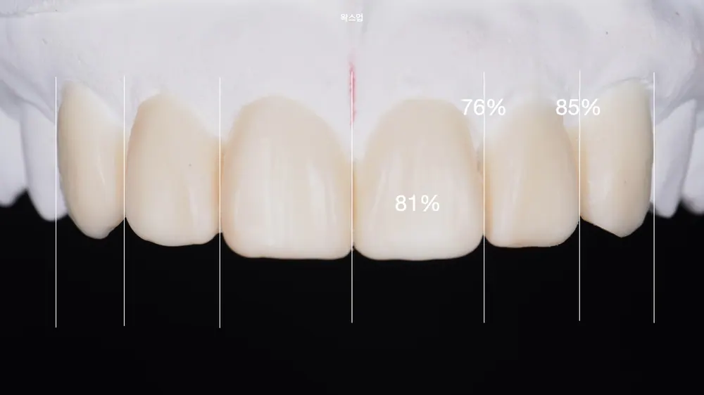 어두워진 라미네이트 고민이라면? 핸드메이드 라미네이트 재시술로! 본문 사진 5
