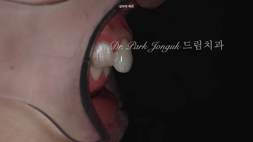 오래된 크라운 재시술과 라미네이트 치료를 조화롭게 치료하기 본문 사진 3