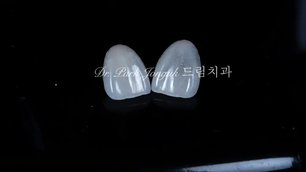 무삭제 라미네이트 정말 삭제 없이 가능한가요? 본문 사진 7