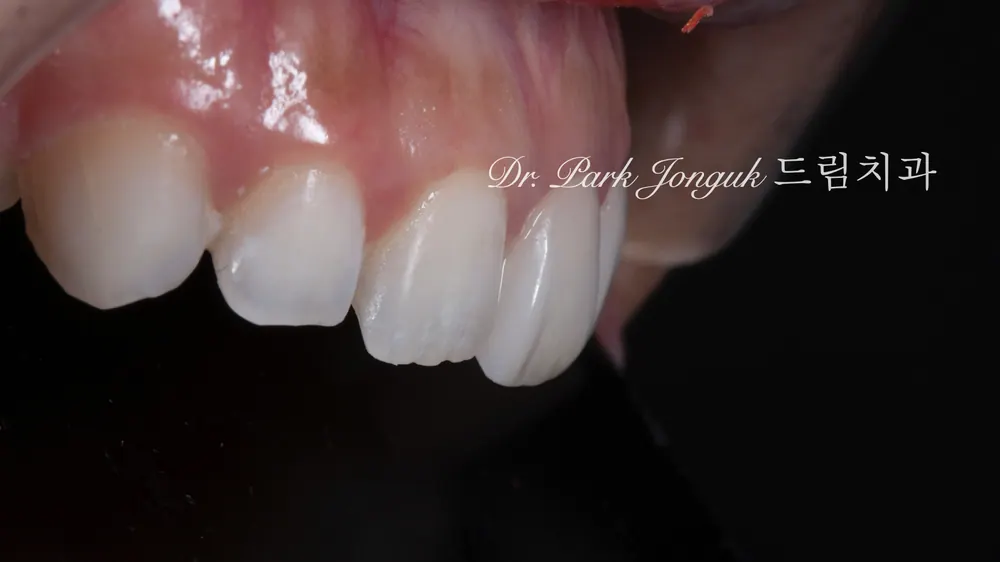 무삭제 라미네이트 하기 전에 정확하게 알아보기! 본문 사진 7