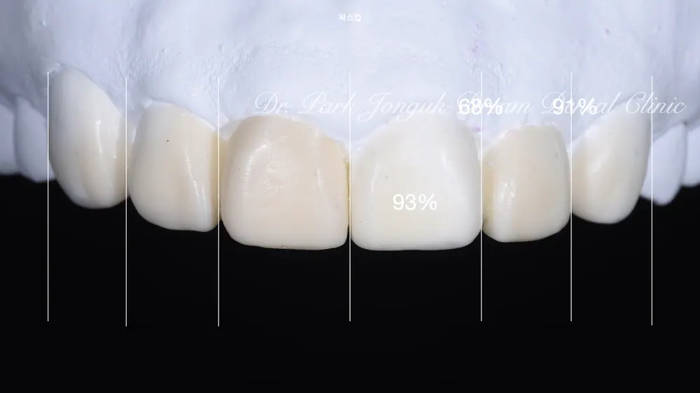 크라운과 라미네이트 차이 안나게 시술이 가능할까요? 본문 사진 6